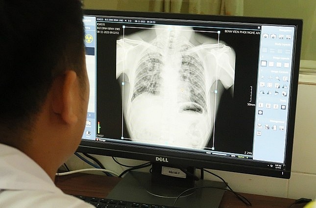 Vụ công nhân bị bệnh bụi phổi silic đặc biệt nghiêm trọng: Nguyên nhân do đâu?